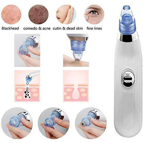 Blackhead & Acne Pore Cleanser Removal kit